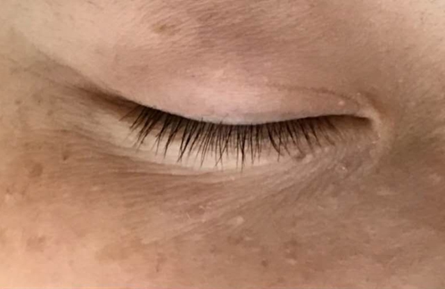 8岁小孩额头破了缝针还是不缝好